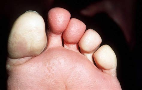 white feet|Raynaud’s Disease & Syndrome: Symptoms, Causes, Treatment